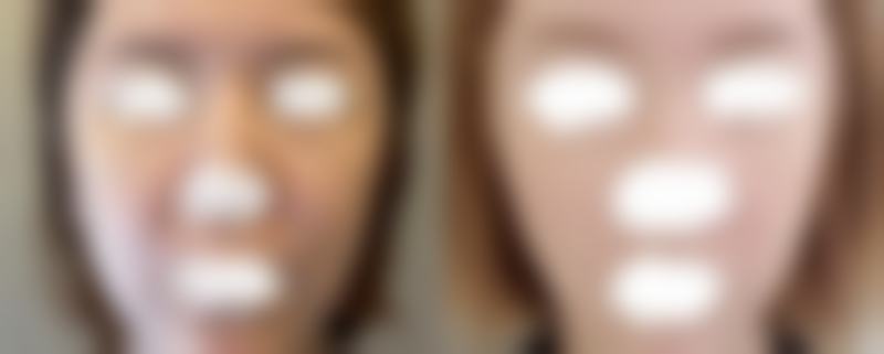 公主小脸馒化针与其他医美项目的搭配