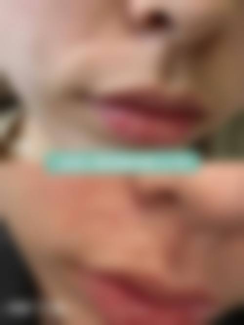 烧伤疤痕修复的注意事项