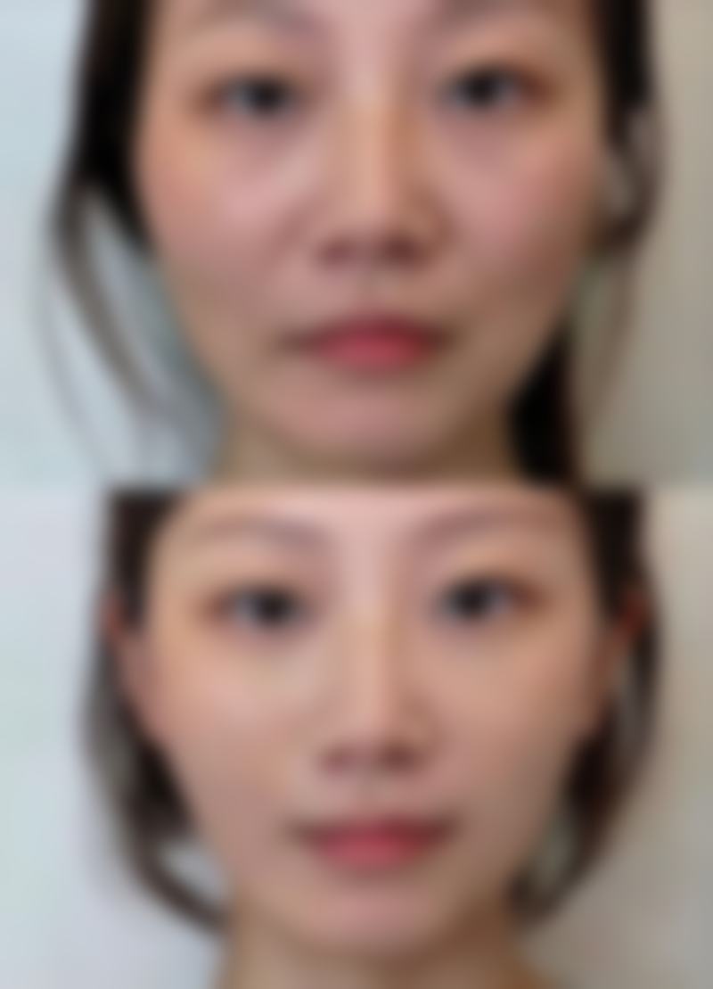 隆鼻手术价格:3千起塑造精致鼻型