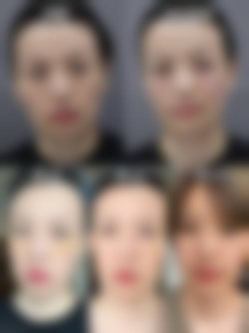 帅楠眼袋贴副作用的预防措施