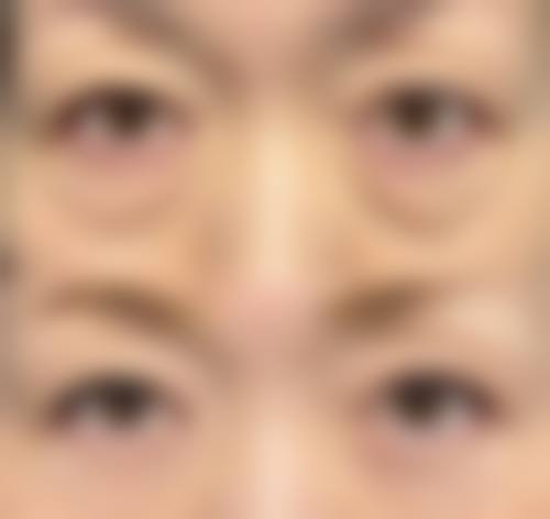 帅楠眼袋贴使用人群与副作用差异