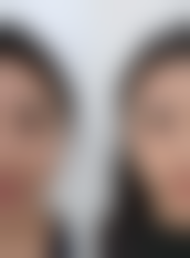 沈阳杏林提眉,附加项目左右费用