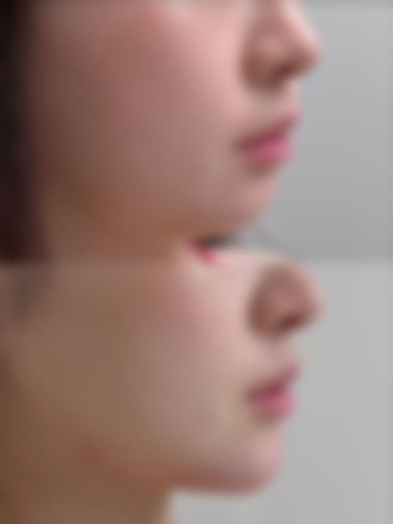 三、瘦脸针剂量与咬肌情况的关系