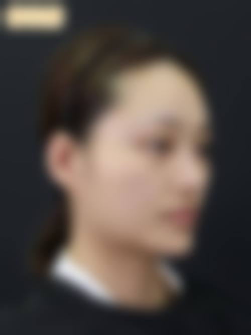 五、上海时光下颌角整形修复快的秘诀是什么？