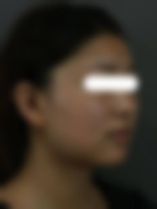 八、如何选择上海时光做下颌角整形？