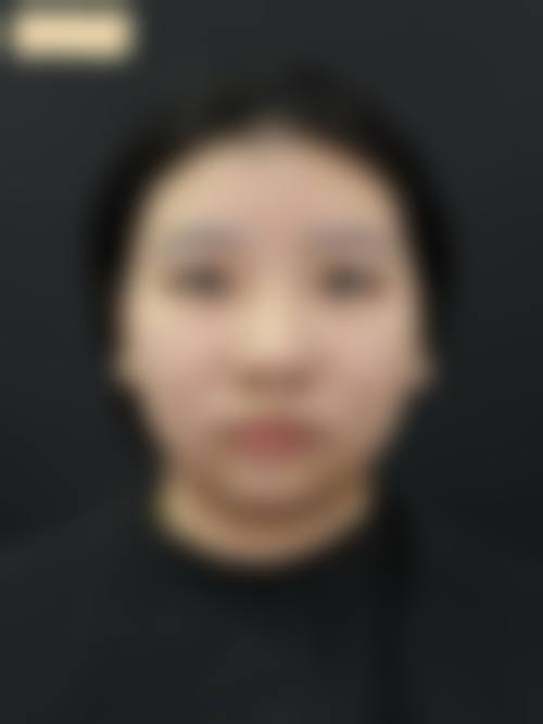 上海时光做下颌角怎么样？精细微创技术+强大医生团队，效果自然恢复快！ 