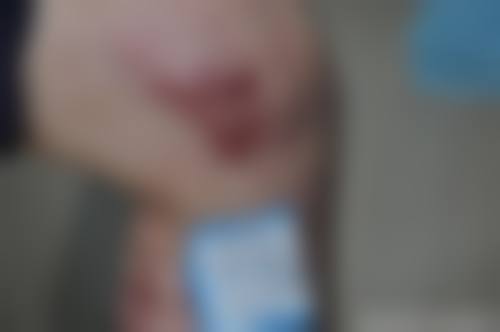 疤痕增生软化过程中的注意事项