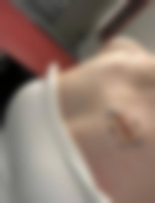 疤痕体质的疤痕治疗医院推荐