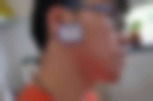疤痕体质的疤痕自己会消除吗？不会！增生性疤痕和疙瘩难自消，需治疗干预