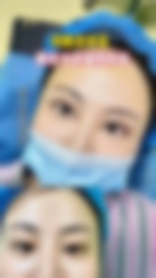 双眼皮修复价格：高低有因细剖析