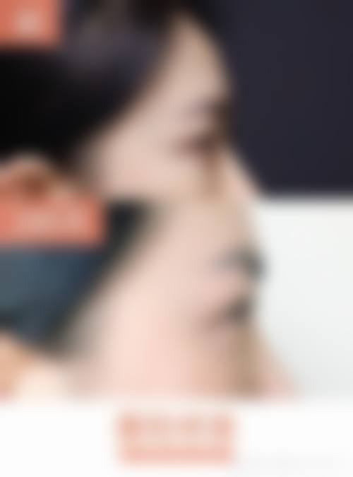 脂肪填充价格：部位不同价不同