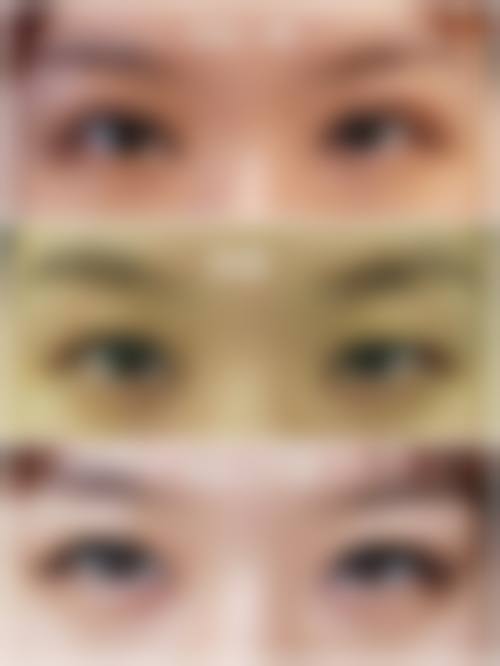 开眼角可以和双眼皮手术一起做吗？联合手术改善眼裂与睑褶形态但需考虑瘢痕风险