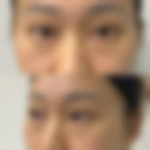 冷敷消肿方法