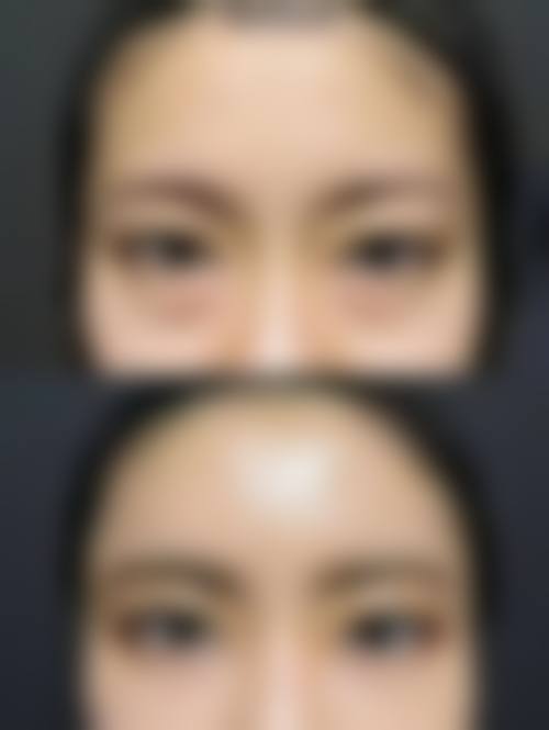 七、去除长期下眼袋的注意事项