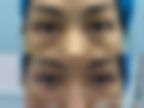 五、其他去除长期下眼袋的方法