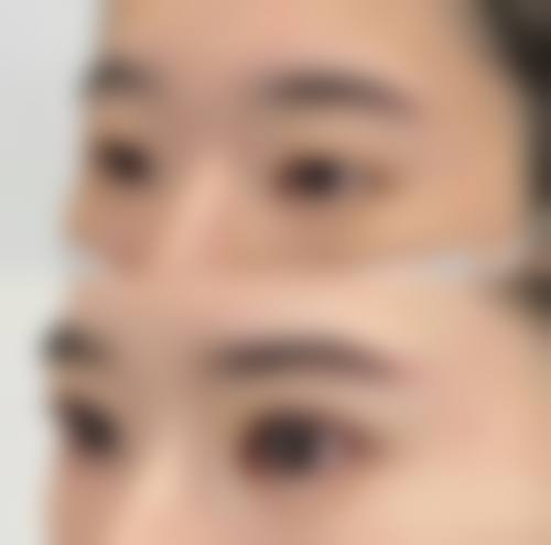 李军军 医生的双眼皮手术风格