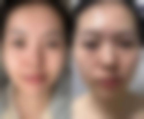先天性眼袋能去除吗:非手术疗法