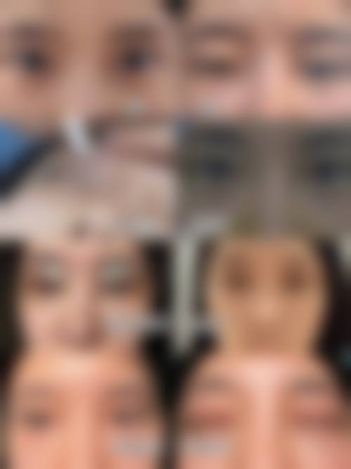眼部整形新秀:广州美莱