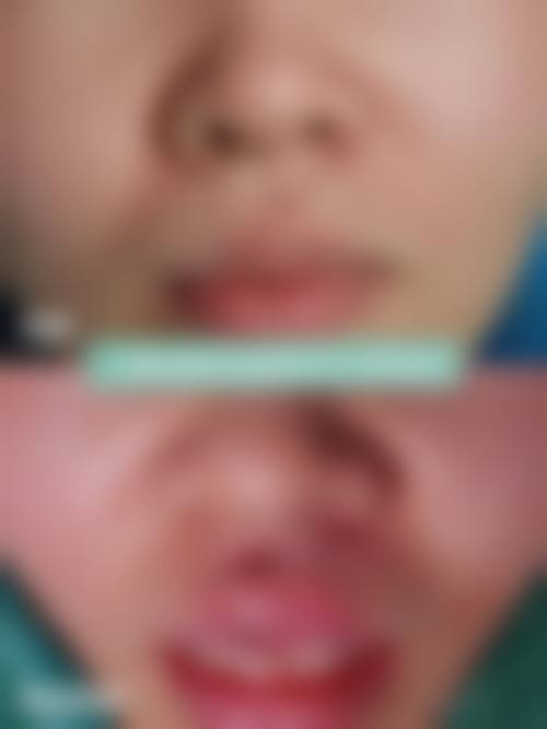 放射疗法辅助修复疤痕