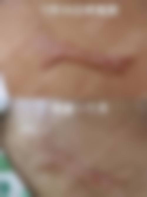 不同类型疤痕的针对性修复