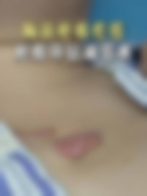手术修复疤痕的选择