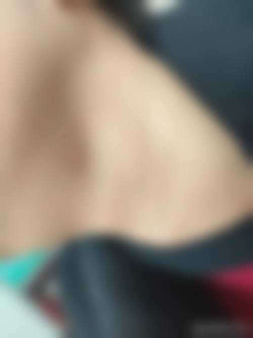 激光修复疤痕的成效