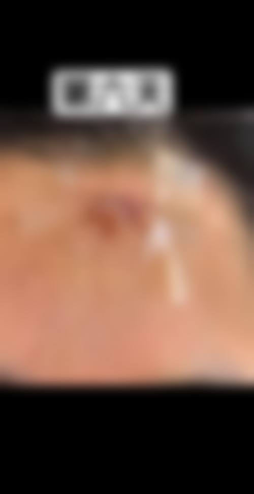 脸上有疤痕有什么办法可以恢复？药物、激光、手术等多种方式助你修复疤痕