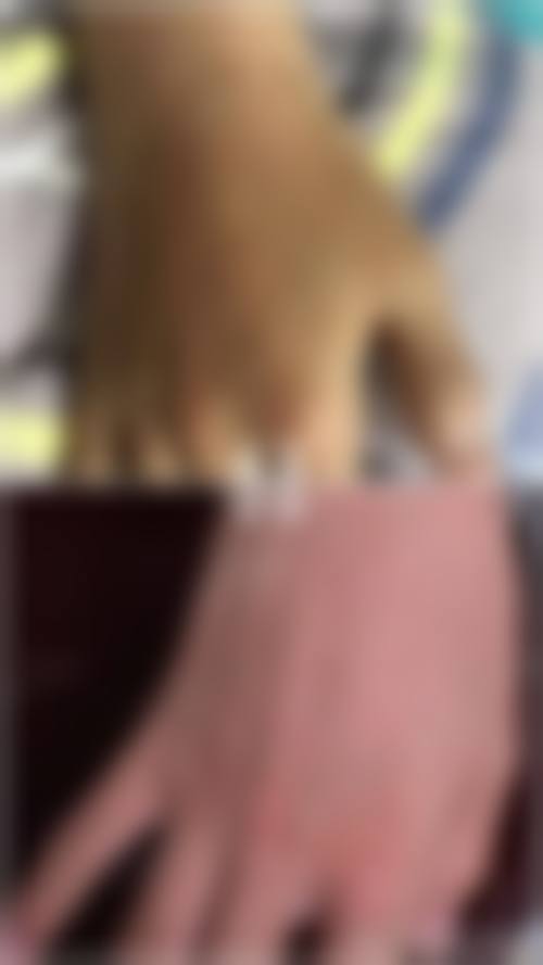 沈阳华美疤痕医院咋样？患者口碑相当不错