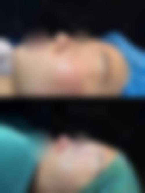 牡蛎让隆鼻后修复加速的秘密武器