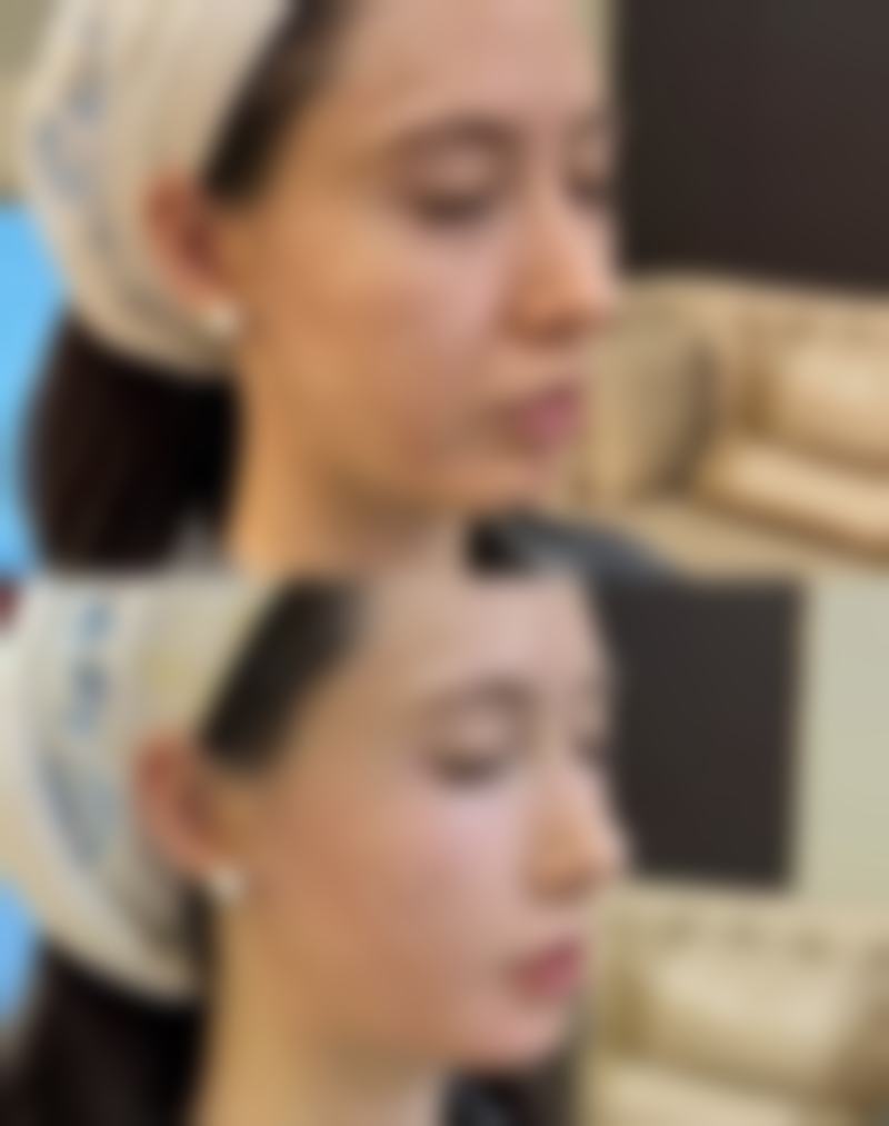 自体脂肪丰臀多久可以正常坐之长期修复情况