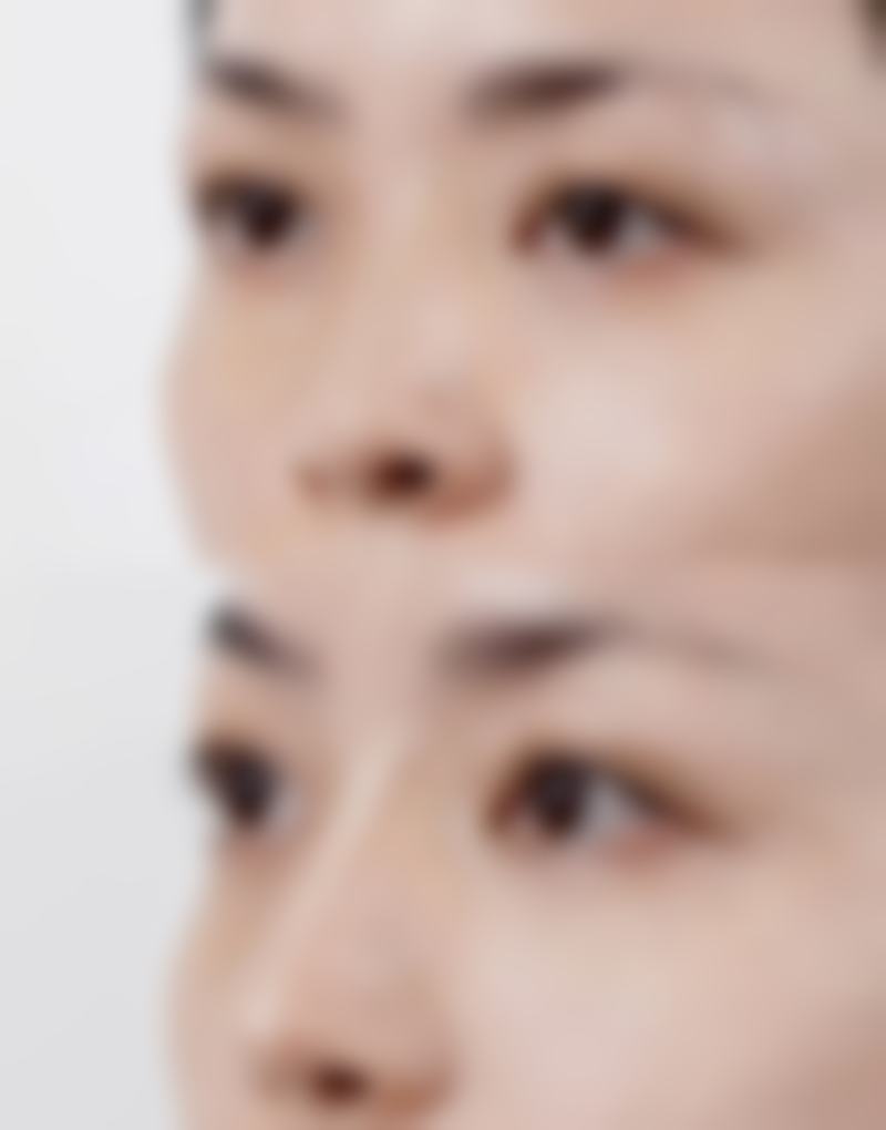 自体耳软骨隆鼻修复过程中的注意事项