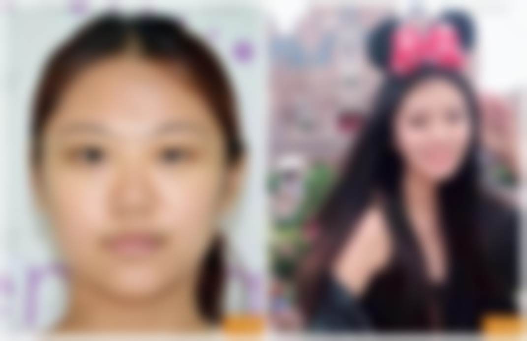 北京禾美嘉医疗美容瑞蓝2号玻尿酸填充3100元起，任学会院长亲诊打造自然直鼻、微翘鼻尖效果 