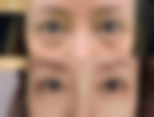 长期有黑眼袋的改善建议