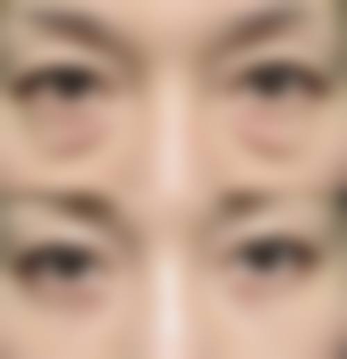 长期有黑眼袋与身体脏腑问题