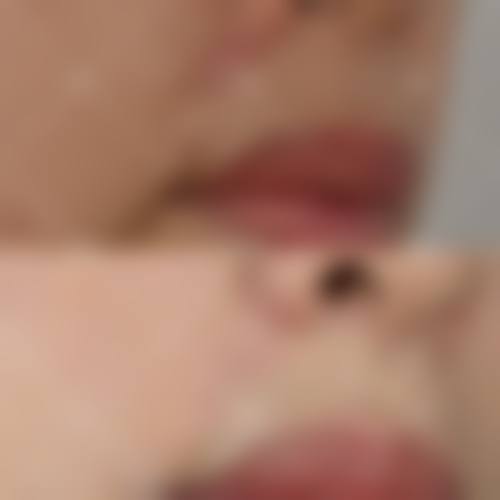 影响疤痕疙瘩修复的因素
