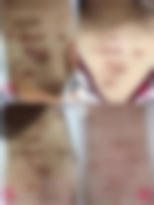 疤痕疙瘩修复的注意事项