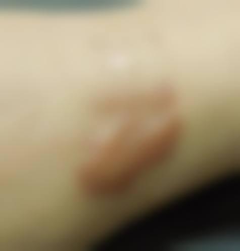 疤痕疙瘩的治疗方法与修复可能性