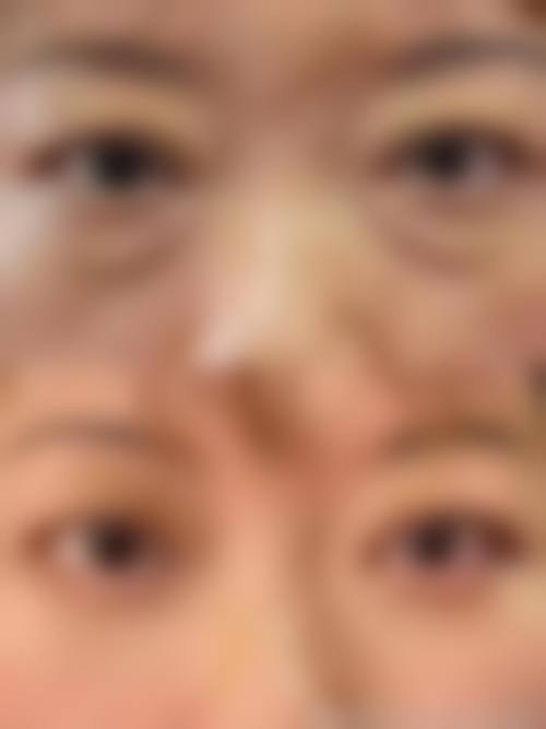 怎么去除黑眼圈眼袋：局部护理不可少