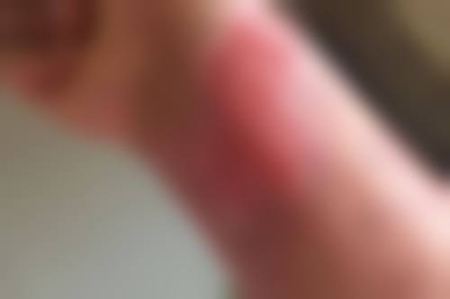 修复疤痕的药膏局限性