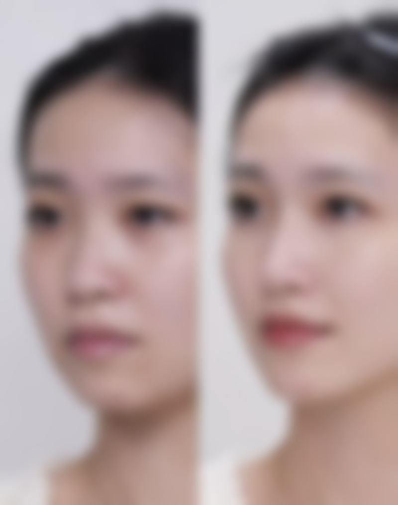 张沙沙医生的眼部整形:自然与精细的理想结合