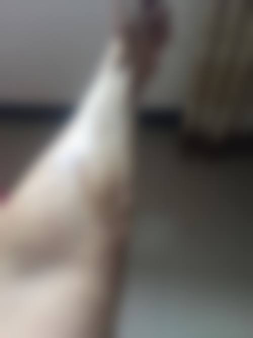 预防措施:从源头减少疤痕产生