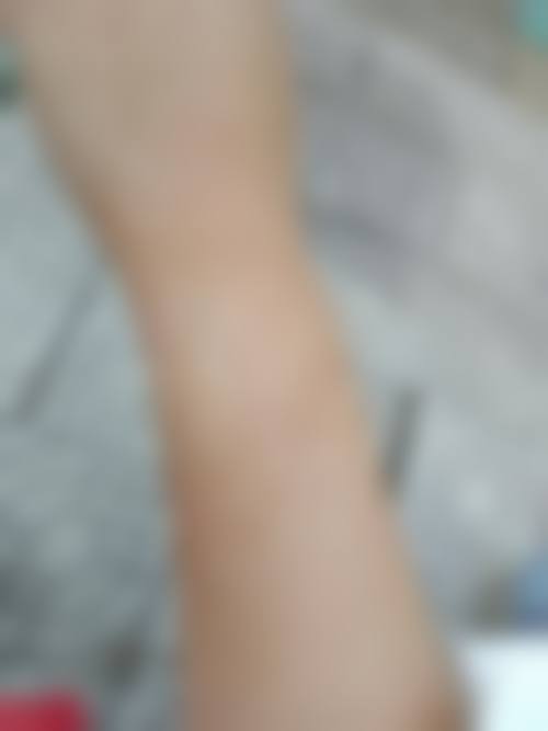 怎样消除烫伤后留下的疤痕？可通过药物、激光、手术治疗，轻微增生激光效果佳！ 