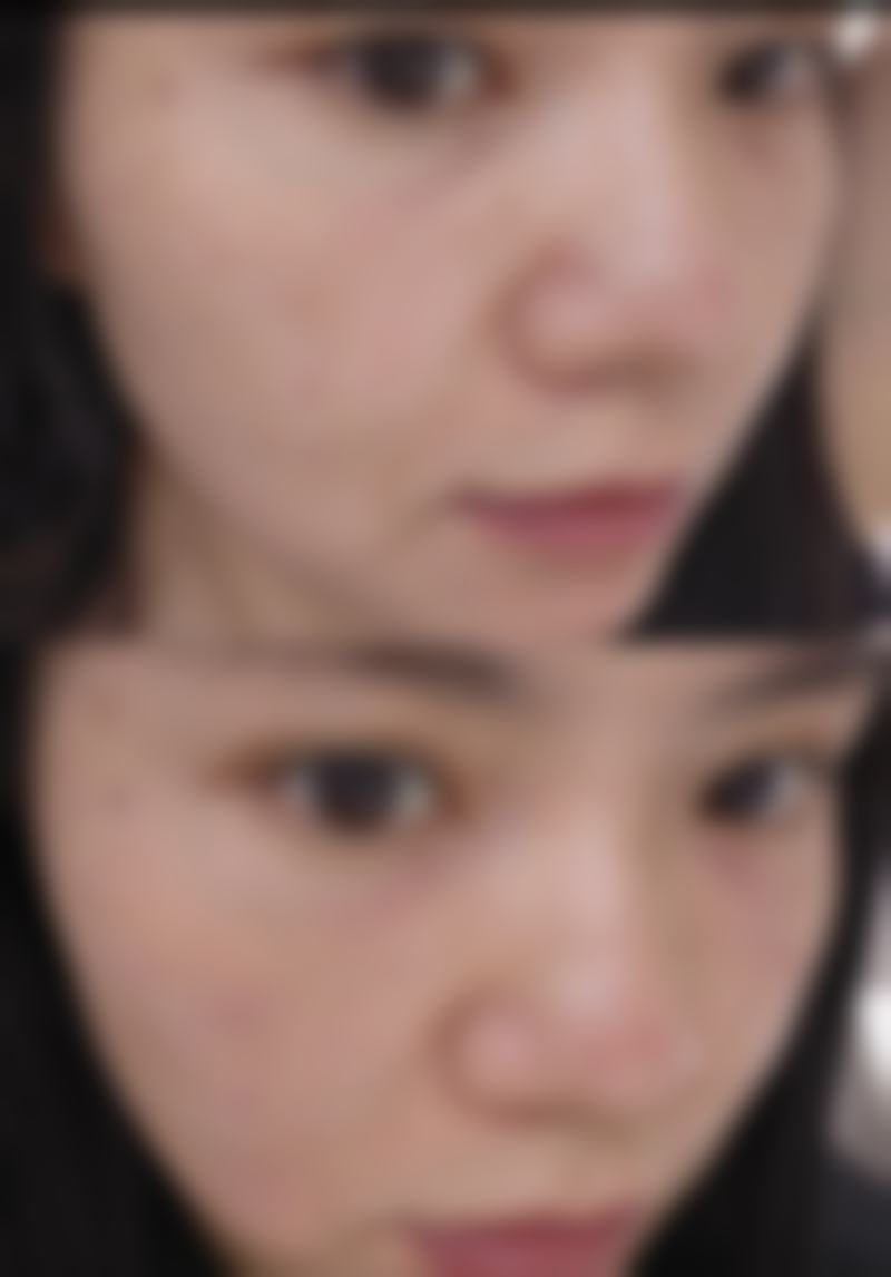 打了瘦脸针十天了怎么还没有效果？或因药物未起效、个体差异及护理不当所致