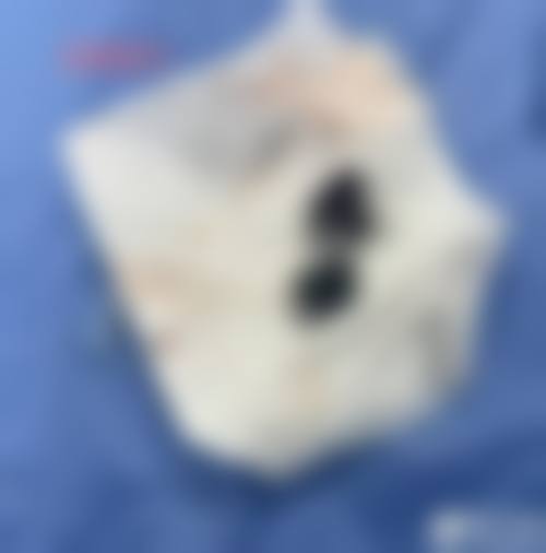 取出隆胸假体后的注意事项