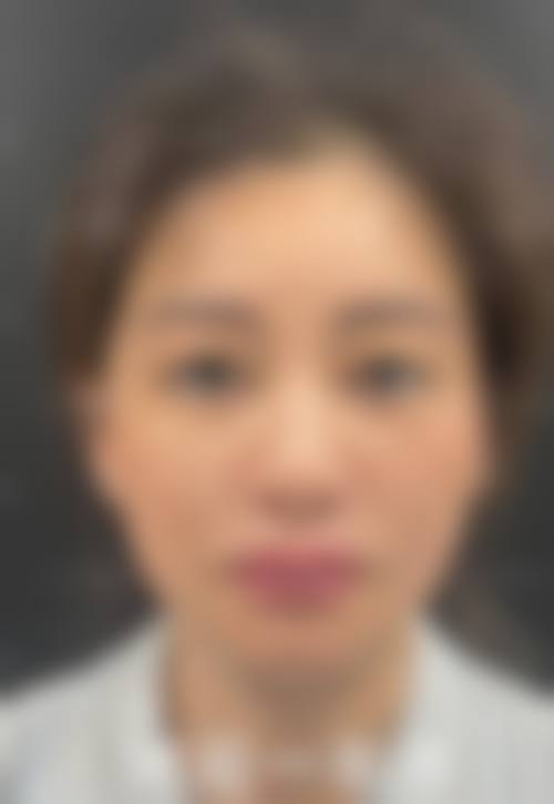蹇洪医生的提升结果评价：做苹果肌复位口内提升成效好、维持3年+，2万多价格很值！ 