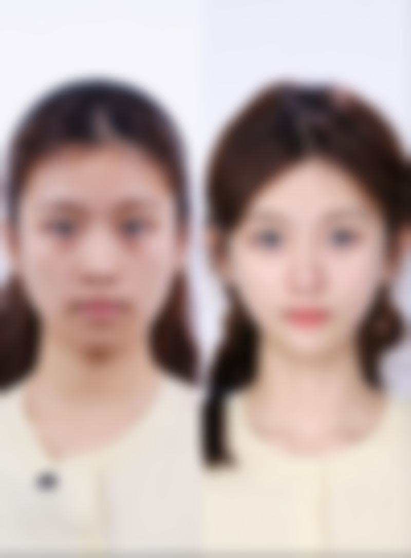 磨骨风格自然，术后宛如妈生脸