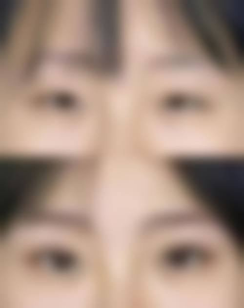 四、疤痕修复的特色