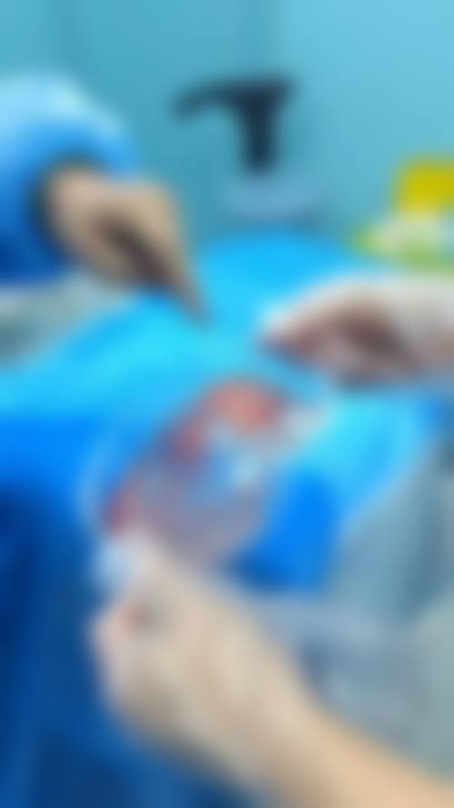 深层提拉:从根源解决面部衰老问题