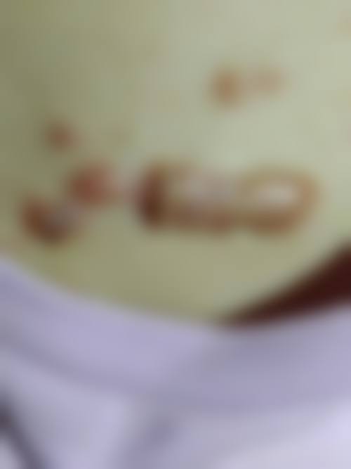 去除疤痕用什么药之药物选择注意事项