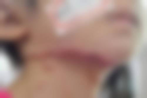 去除疤痕用什么药之疤痕止痒软化膏